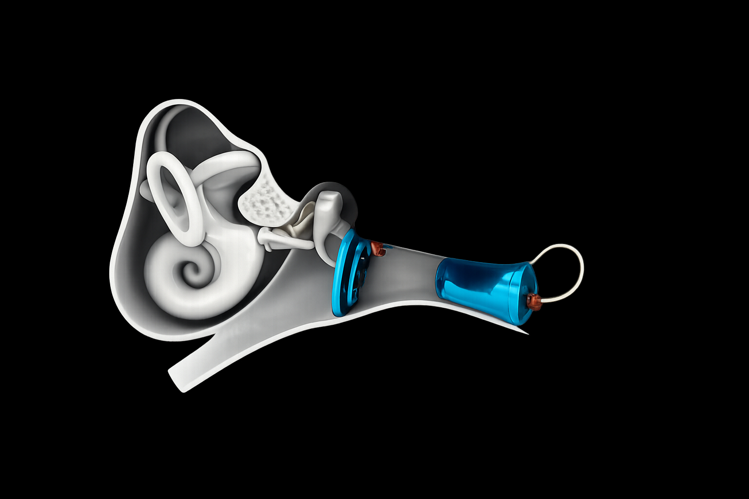 Anatomical cutaway of the ear showing the EarLens lens on the eardrum and the light tip in the ear canal