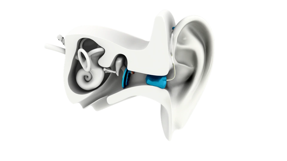 Earlens system shown in an official manufacturer image